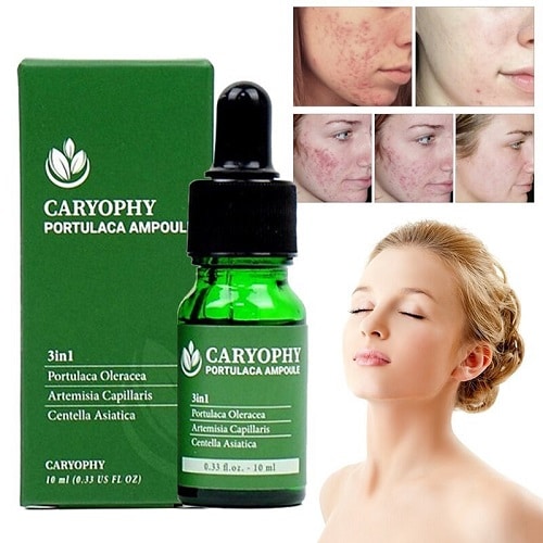 Hình ảnh trước và sau khi sử dụng serum trin mụn Caryophy